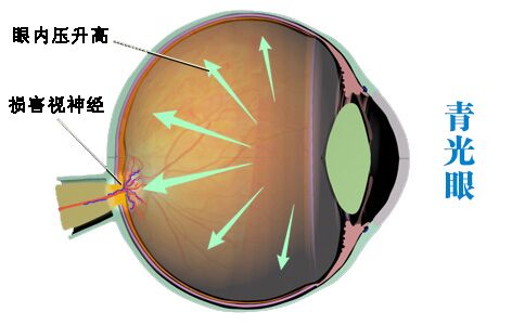 眼睛胀痛是怎么回事? 青光眼的早期症状有哪些?
