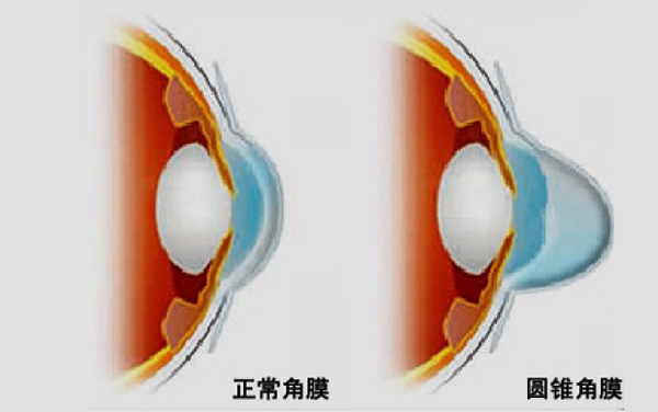 怎么圆锥角膜