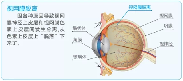 视网膜脱离啥症状？这张图告诉你！