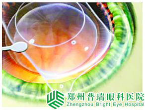 【专家解读】近视手术的安心性