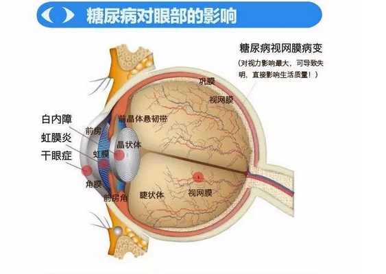 你造吗？糖尿病晚期眼睛会失明！