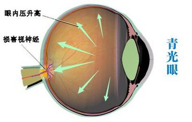 【详解】诱发青光眼的原因
