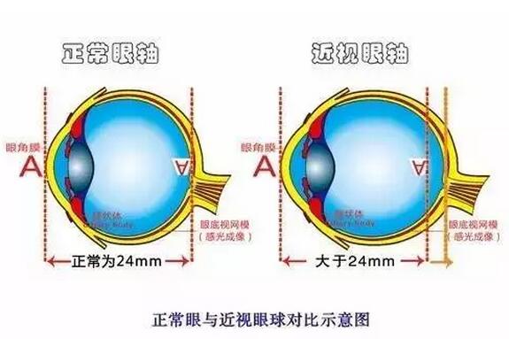 近视超过600度以上？这7条“锦囊”请收好！