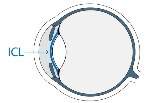 ICL晶体植入术，矫正的高度近视“神器”