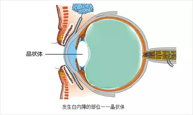 眼科主任告诫白内障这几大误区，80%的老人上当