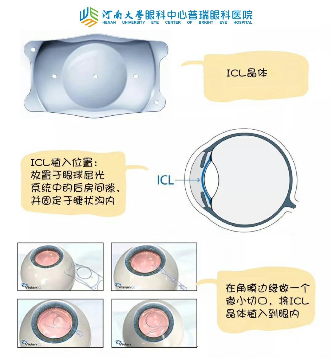 近视度数太高，还能做手术吗？