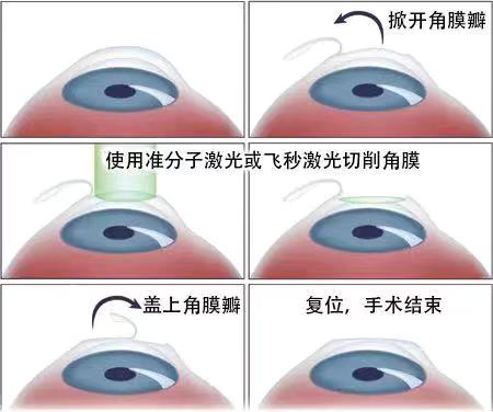 如果眼睛近视了该怎么？