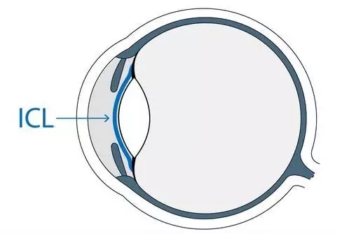 想做ICL晶体植入术，你需要了解的全在这里!